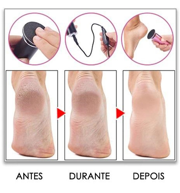 RemoFlex -Removedor de Calos -FootCare Pro